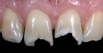 Figure 1 Close-up preoperative retracted view of the patient’s central incisors demonstrating
the extent of damage from sugar and oral disease.