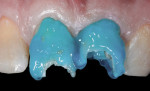 Figure 3 A total-etch technique was performed on the dentin and enamel.