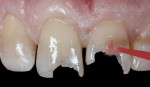 Figure 4 After rinsing and drying, an adhesive bonding agent was applied and light cured.