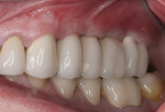 Figure 22 Splinted implantsupported prosthesis, site Nos. 12 through 14 (restorative dentistry performed by Alain Roizen, DDS, New York, New York).