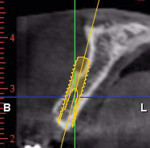 Figure 4 Case 1: CBCT cross-sectional view of site No. 7 revealed inadequate ridge width to support a 3.3-mm diameter implant in ideal restorative position.