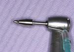 Figure 6 2-mm twist drill with adjustable stop used to create pin osteotomies.