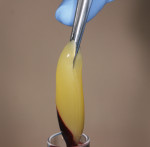 Figure 3 L-PRF is easily withdrawn from the tube with college pliers.