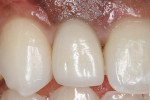 Figure 15 Final screw-retained restoration No. 7 (restorative dentistry performed by Michael Woloch, DDS, New York, New York).