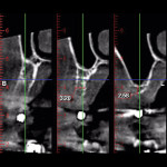Figure 17 CBCT cross-sectional views of site Nos. 12 through 14 revealed vertical and horizontal bone deficiencies.