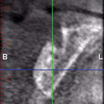 Figure 12 6-month postoperative CBCT cross-sectional view revealed ridge had more than doubled in width to the full apical extent of the grafting procedure.