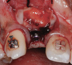 Figure 14 3-mm healing cap and L-PRF membranes inserted just prior to primary closure to increase marginal soft-tissue volume.