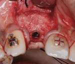 Figure 13 Ridge augmentation permitted implant placement in ideal prosthetic position.