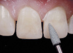 Figure 11 Transitional line angles, certain aspects of micromorphology, and the center third of tooth No. 9 were properly managed and optimized.