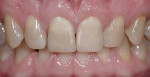 Figure 13 The proper value of the adjacent teeth was achieved in the restorations.