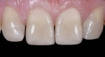 Figure 14 The 1:1 postoperative view demonstrates the desired value, outline form, and natural esthetics.