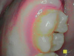 Figure 4 View of Figure 3 in Perio mode. Soft bacterial deposits are white, calcified deposits are orange-yellow, and inflamed tissues are purplish-pink-red.