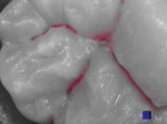 Figure 6 The biofilm is removed from the occlusal grooves with air polishing to complete the evaluation. The presence of caries is indicated by the red in Cario mode.