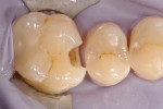 Figure 1 Preparation of tooth No. 16, which presented with mesial caries with fractured marginal ridge.