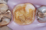Figure 3 Situation after preparation of tooth No. 19, which presented with a fracture of the lingual wall and cracked buccal cusps.