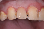 Figure 2 After decay removal, Mylar matrix placement and total phosphoric etch, a
bonding agent was used followed by a thin layer of Beautifil Flow Plus and finished
with Beautifil II composite.
