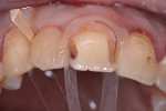 Figure 3 A contoured matrix was used to form a good gingival seal, keep out crevicular fluids, and provide anatomic form to the material.
