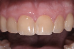 Figure 4 Maxillary
anterior restorations were finished using giomer material and enhanced with
Super-Snap disks. A final 20-second cure was then applied.