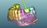 Figure 2 The direct placement of a virtual implant from within the planning software. Adjacent teeth have been segmented as separate objects.