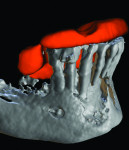 Figure 5 An ill-fitting scan appliance. Notice how the appliance was not seated over the incisal edges.