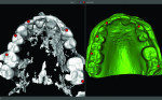 Figure 6 An STL of a model being merged with
DICOM by identifying common reference points.