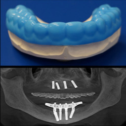 Biocryl Form-X by Great Lakes Orthodontics