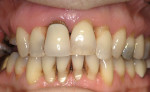 Figure 2a  Gingival recession with exposed root surfaces are susceptible to dentinal hypersensitivity. (A) Example of exposed facial root surfaces.