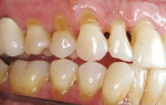 Figure 4  Gingival recession with associated non-carious cervical lesions may have hypersensitivity and need restoration.