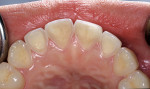 Figure 6  Stomach acid has eroded the lingual surfaces of the maxillary anterior teeth because of bulimia.