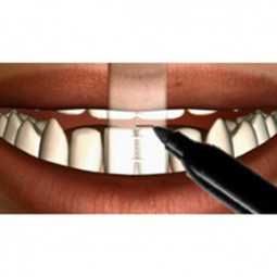 Massad® Dentate Esthetic Functional Space Ruler (DEFSR) by Nobilium