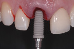 Figure 2. A tapered implant design that incorporates platform switching aids in providing primary stability while preserving crestal bone.