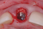 Figure 3. The implant is placed in a lingualized position, and the resulting gap is filled with a xenograft material.