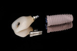 Figure 5. An adequately contoured immediate provisional provides support for the peri-implant tissues and preserves gingival margin levels.