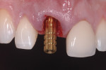Figure 6. Temporary cylinder attached to immediate implant replacing tooth No. 8.