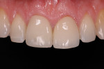 Figure 8. Postoperative appearance of immediate implant and provisional replacing tooth No. 8 shown 6 weeks following procedure.