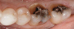 Figure 1 Preoperative photograph of teeth No. 18, No. 19 showing fractured lingual cusps.