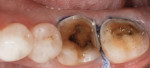 Figure 2 Teeth No. 18 and No. 19 prepared for crownlays. It can be noted that the margins are
supragingival wherever possible.