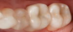 Figure 6 Postoperative photograph
of crownlays on No. 18 and No. 19. It can be noted that the buccal margins blend in very nicely with the existing tooth structure.