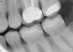 Figure 7 Postoperative radiograph after cementation of the crownlays shows excellent marginal seal, contours and interproximal contacts on teeth No. 18 and No. 19.