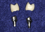 Figure 7 CAD/CAM milled titanium custom abutments upon which CAD/CAM milled zirconia based with Ceramics 2in1 overlayed porcelain crowns have been fabricated