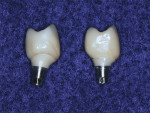 Zirconia CAD/CAM milled crowns seated on the zirconia milled abutments that have been luted to the titanium connectors.