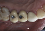 Figure 12 Occlusal view showing the monolithic zirconia CAD/CAM milled screw-retained crowns.