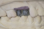 Figure 13 Buccal view of CAD/CAM milled titanium
bases ready for porcelain placement
to finish screw retained crowns.