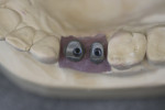 Figure 14 Occlusal view of CAD/CAM milled titanium bases ready for porcelain placement to finish screw retained crowns.