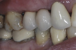Figure 16 Buccal view of porcelainfused-
to-titanium screw-retained single unit
implant crowns.