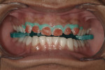 Figure 4 Two 20-minute applications of 40% hydrogen peroxide placed from canine to
canine on the upper arch.