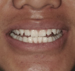 Figure 5 In-office bleach has been removed, along with gingival barrier, IsoBlock, and cheek retractors.