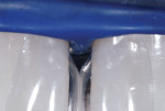 Figure 4 High magnification view of No. 8 to
No. 9 interproximal area with two Bioclear DC-201 Matrices fully seated. This back-to-back
placement to treat two approximating teeth and the entire papilla area at once is the
preferred method.