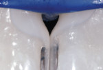 Figure 5 (High magnification view of the initial placement of flowable body shade B-1 before subsequent injection of heated paste into the flowable “wash.”