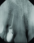 Figure 3 Nonrestorable tooth No. 7 as a result of subosseous root fracture with midbuccal bone loss.